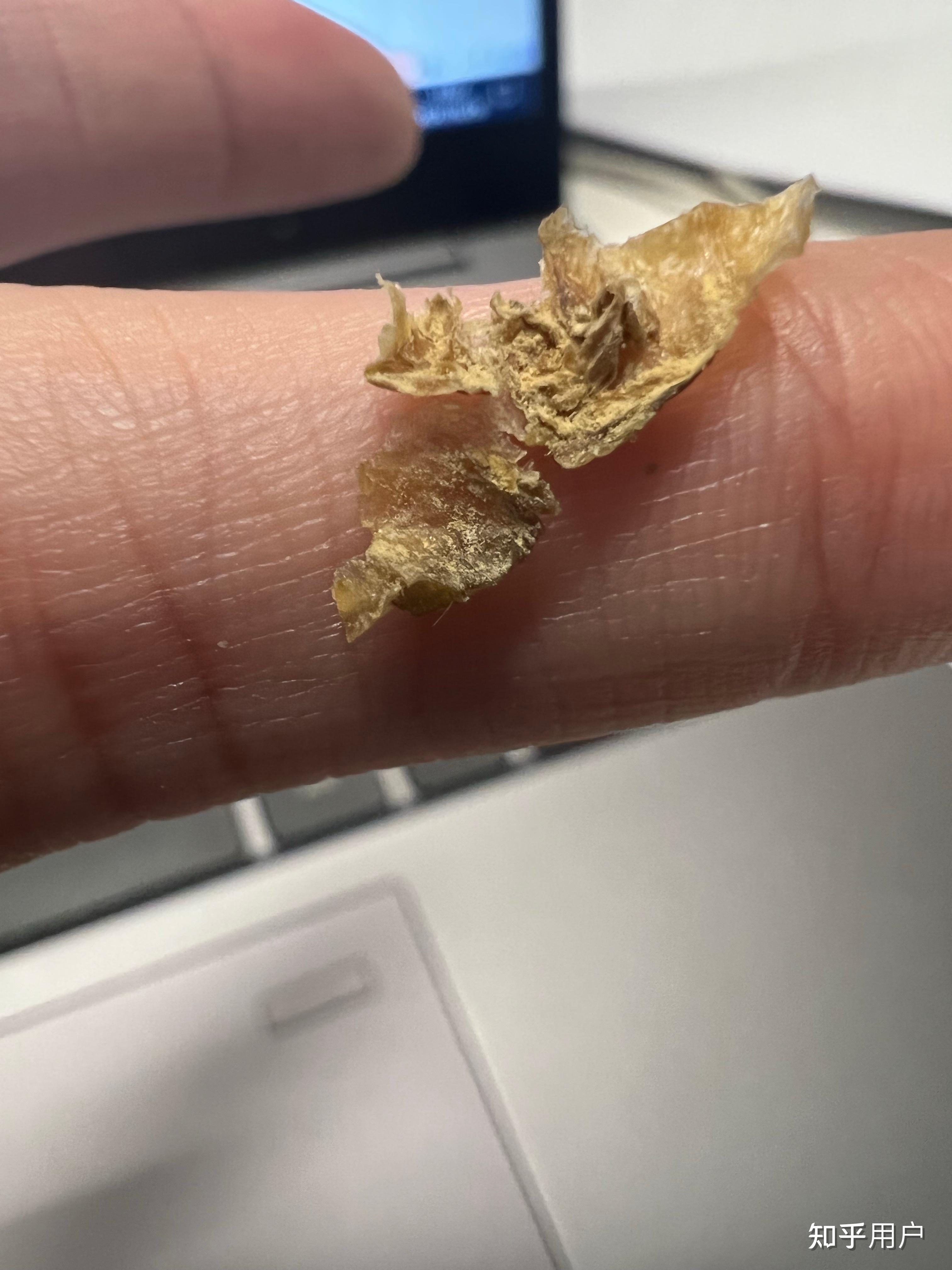 为什么我掏出来的耳屎是桶状的就是一层薄膜粘附在耳壁上