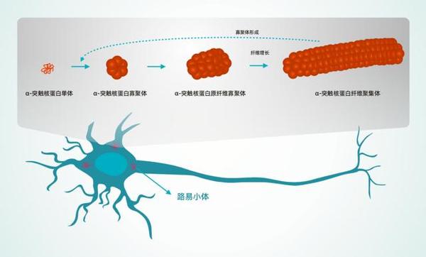 路易小体,帕金森的主要病理特征之一