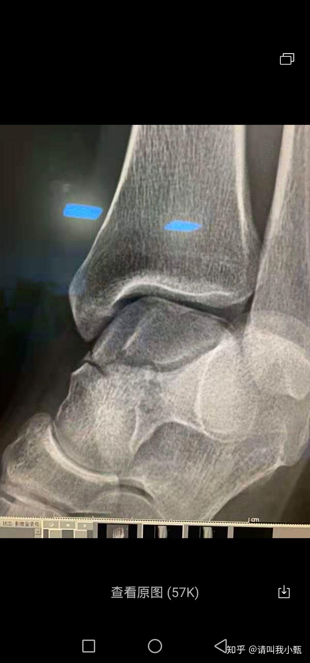 结果就是这个导致意外……左脚外踝撕脱骨折,距骨粉碎骨折