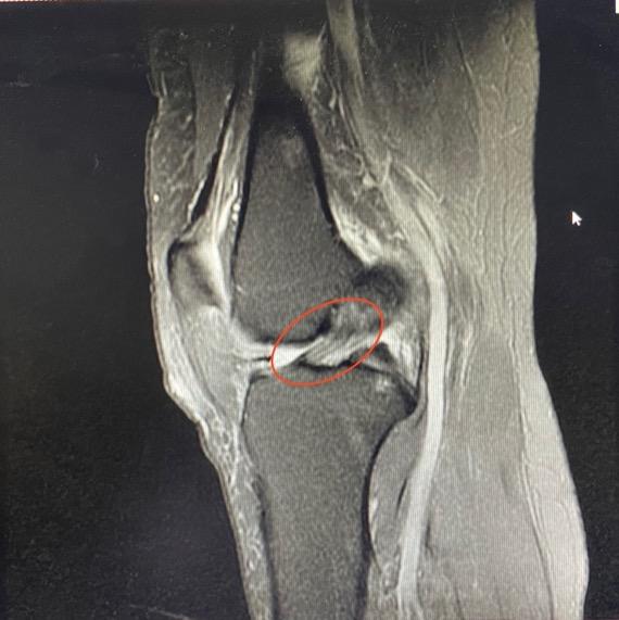 患者故事:今天来说说,膝关节韧带损伤那些事情 