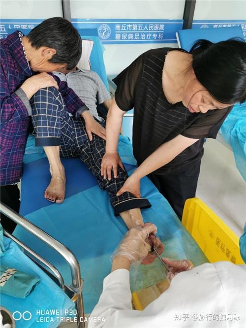 糖尿病足溃烂比较严重,可以不截肢治好吗? - 知乎