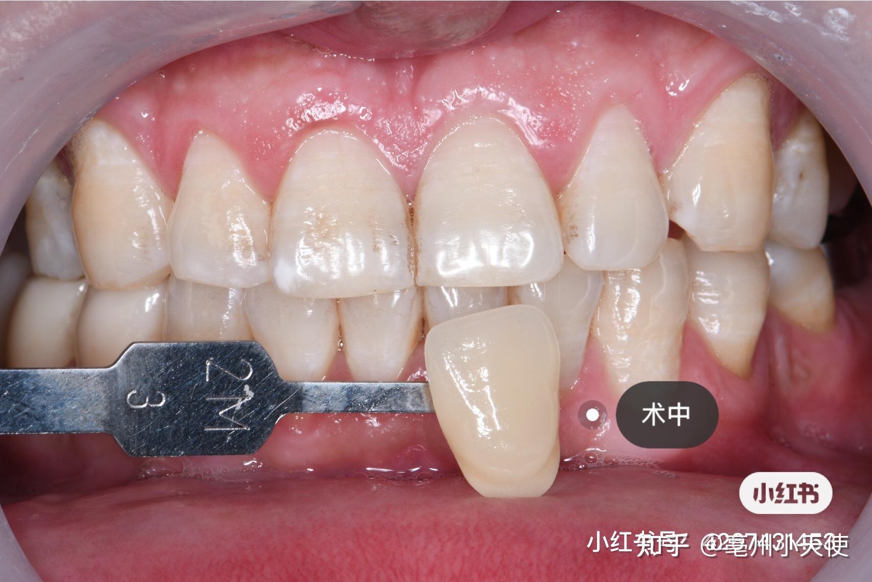 分享小朋友的歪牙使