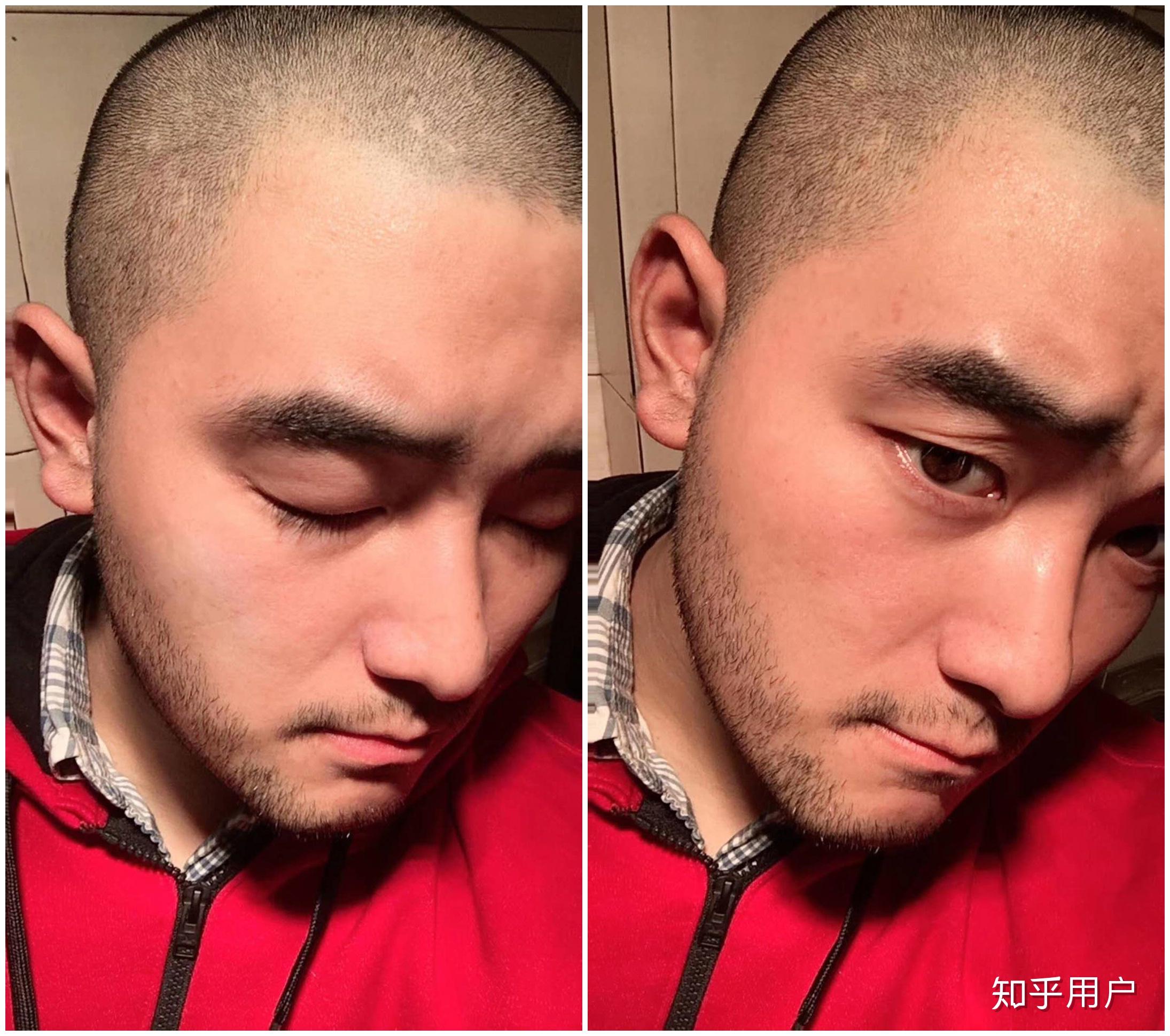 脱发,剃个光头需要多大勇气? - 知乎