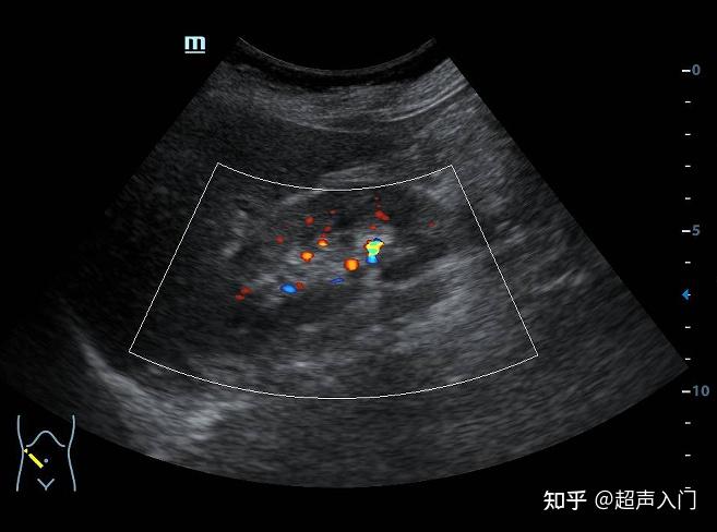 晚上值班一开始我真没看见这个肾结石
