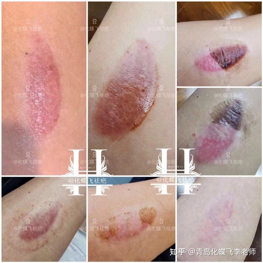 烫伤疤痕修复 - 知乎