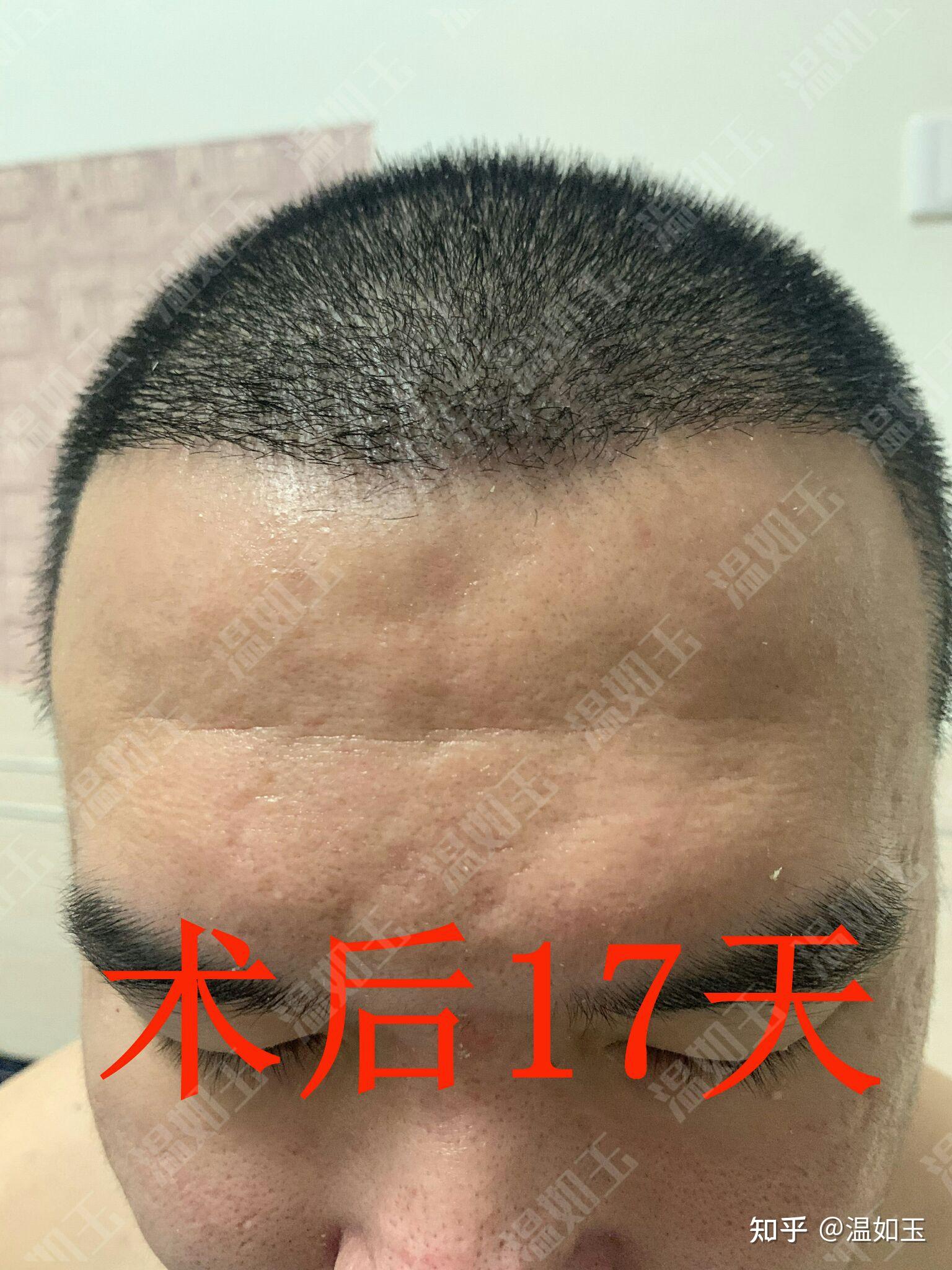 成都有植发吗(成都哪些植发医院属于正规医院?)