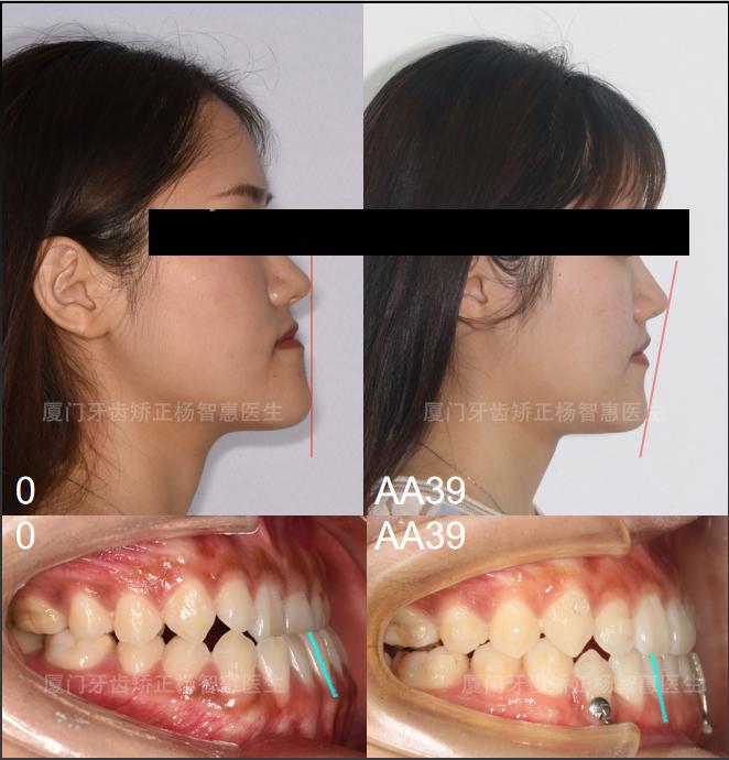 廈門牙齒矯正成年人骨性地包天不想做手術還有改善空間嗎楊智惠院長