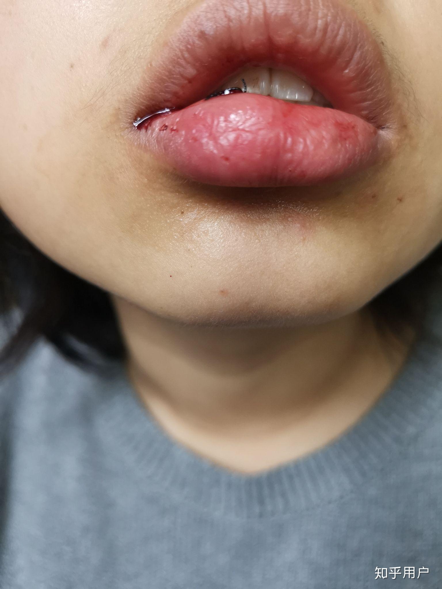 嘴唇粘液腺囊肿手术后?