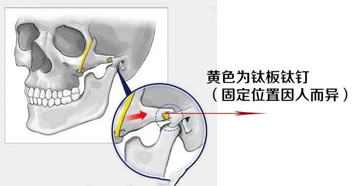 下頜面整形術重塑臉型的完美解方