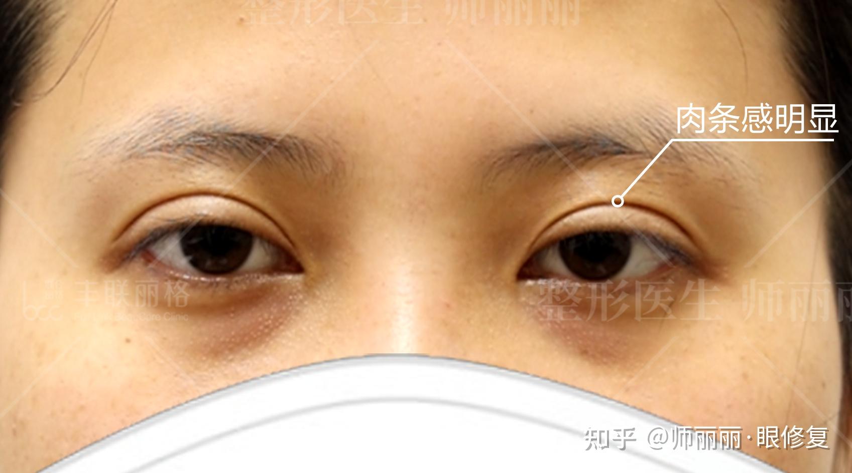 两条疤的不成型双眼皮修复 - 周兆平整形网