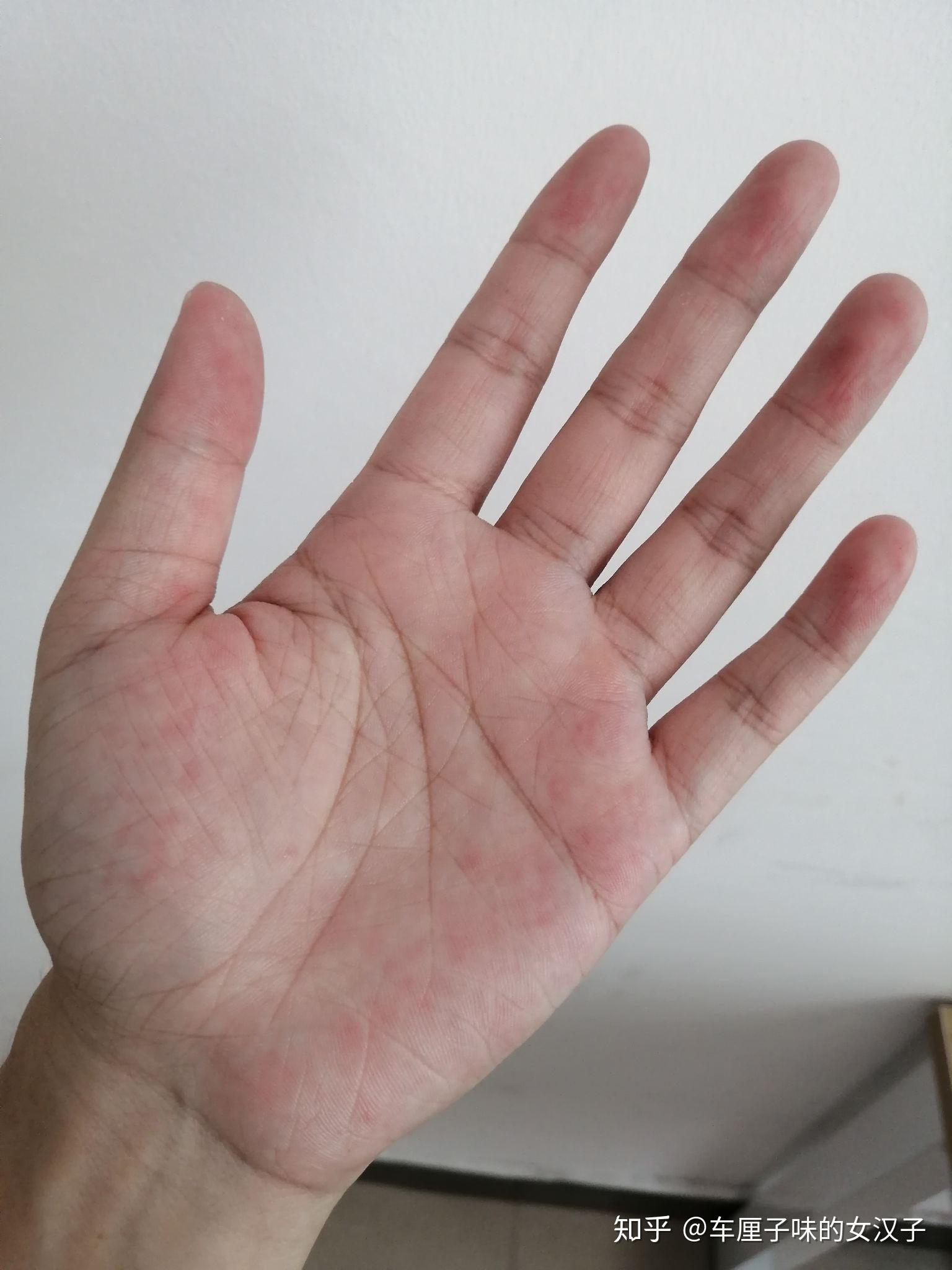 我只是想问手脚天生的很粗糙纹路深很红也比一般人的手热手就像没有