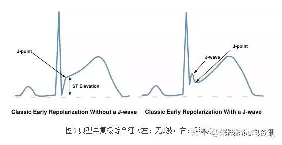 j波(osborn波)