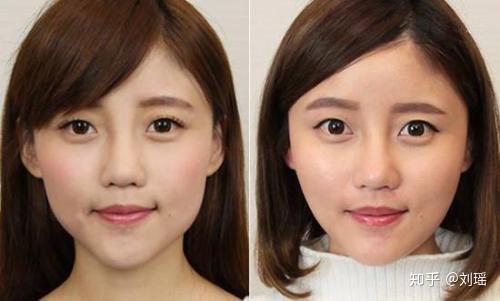 科普打完痩脸针后为什么会脸颊凹陷