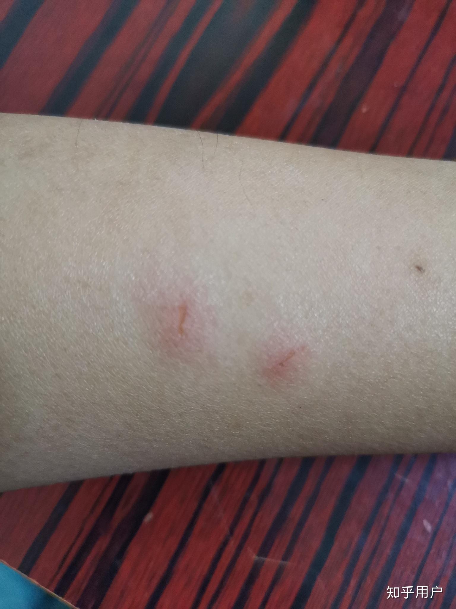 刚刚被猫抓伤了出了一点血,大概是表皮的,我刚刚舔了一下伤口,用不用