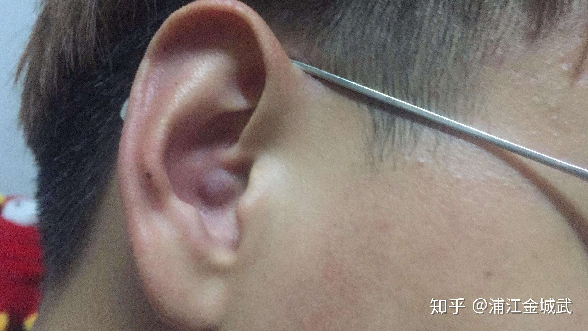 【案例分析】小耳畸形患者时隔一年回院做二期手术，患者重获“新”耳朵 - 哔哩哔哩