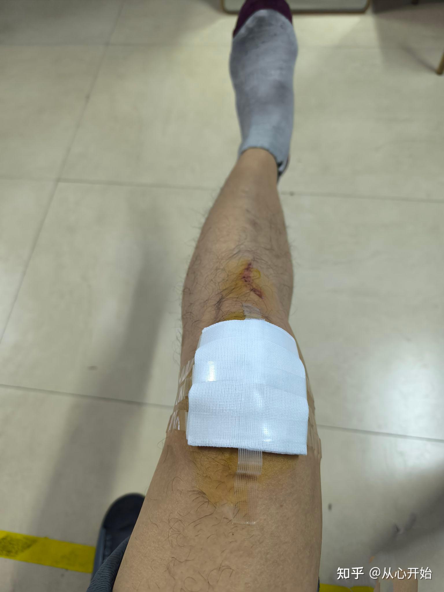 记录膝盖摔伤恢复过程