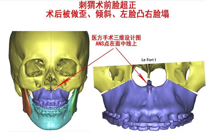 国内正颌做的牛逼的医生有哪些? 正颌手术有必要国内都看嘛? - 知乎