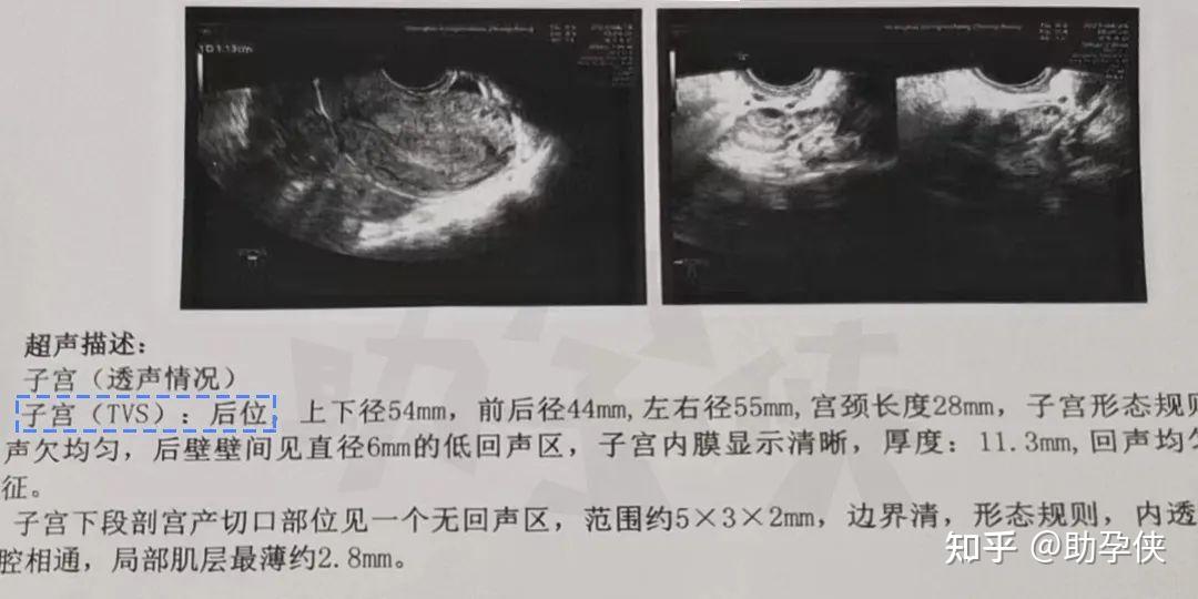 子宫后位应该采用怎样的姿势和事后该怎么躺着可以提高受孕几率? - 知乎