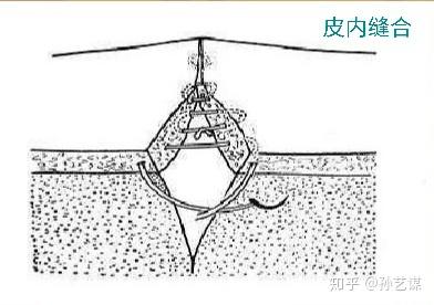 缝合切口的缝线 选需要拆的还是不拆的 知乎