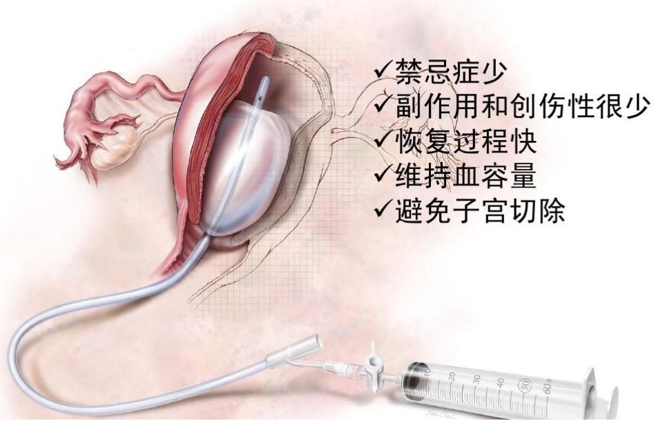 子宫纵隔手术球囊图片图片