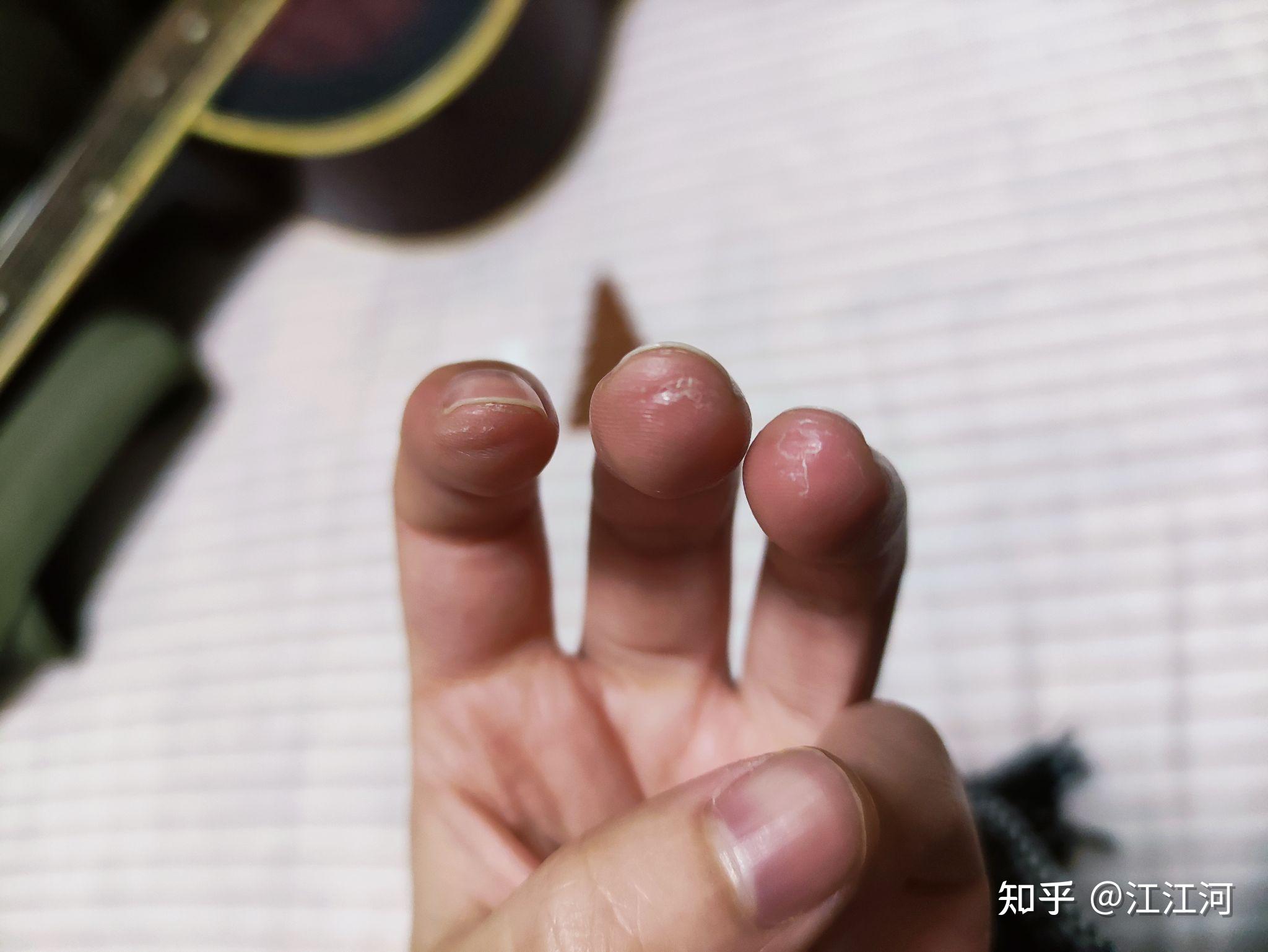 玩吉他的朋友可以拍一张左手手指上的茧吗