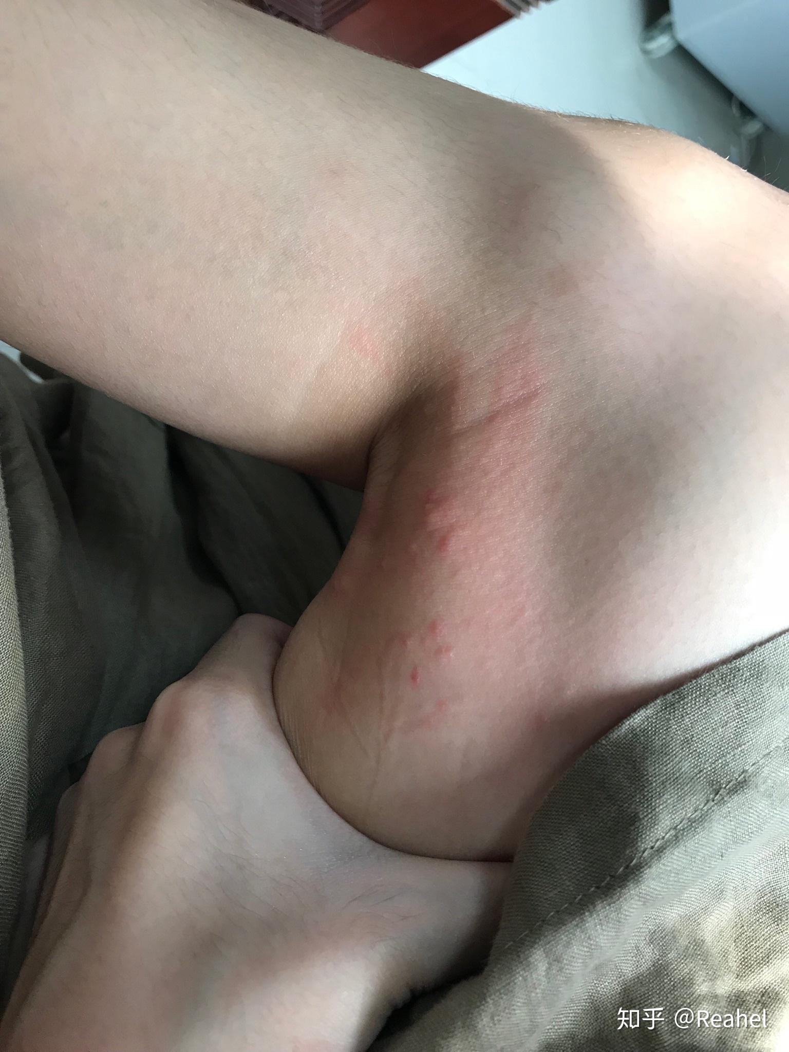 被跳蚤咬的全身都是包是什么样的感受