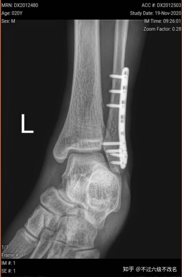 腓骨骨折 知乎