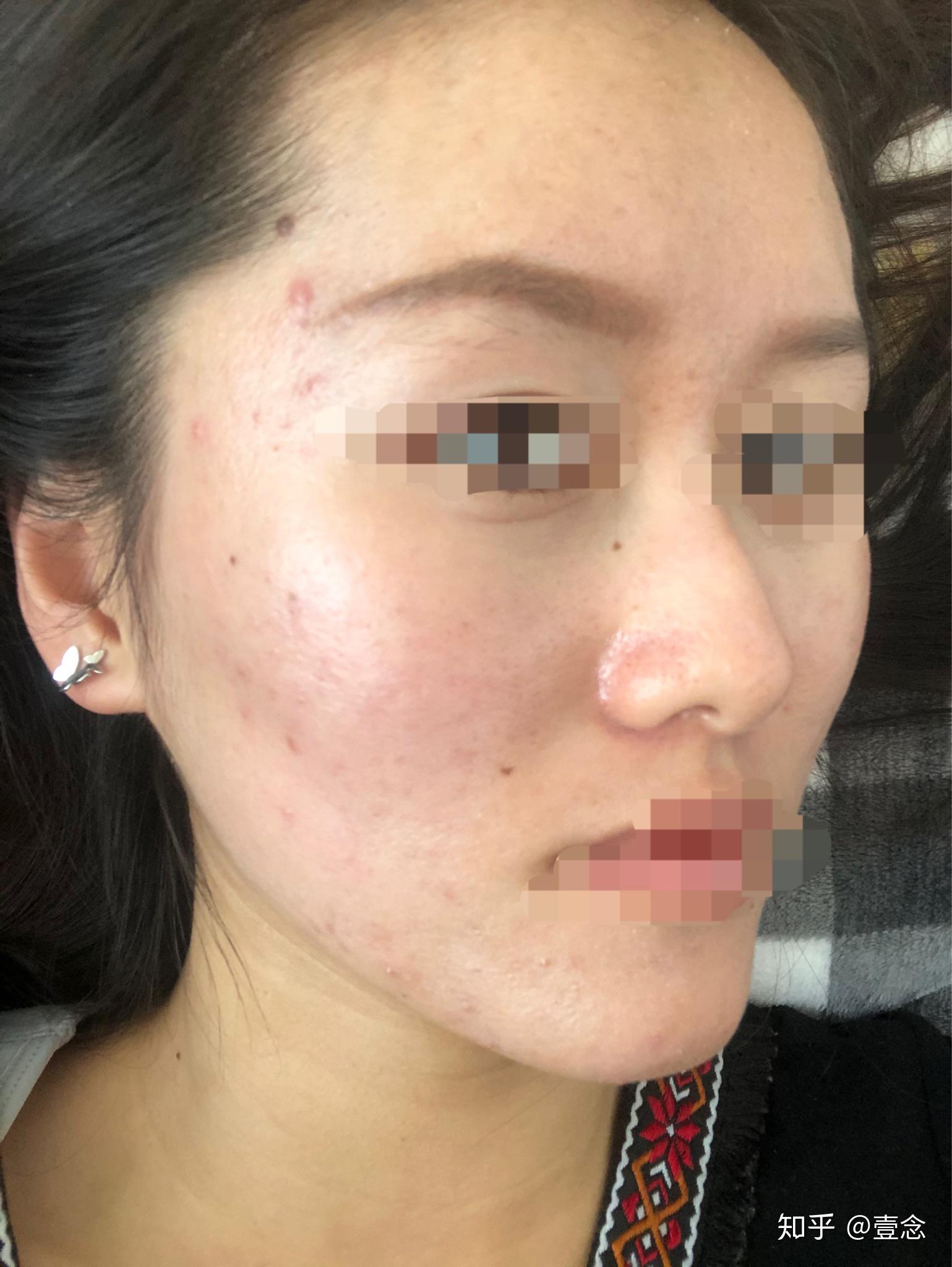 使用阿达帕林记录