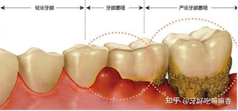 出現牙齦萎縮要及時治療避免出現不可挽回的事