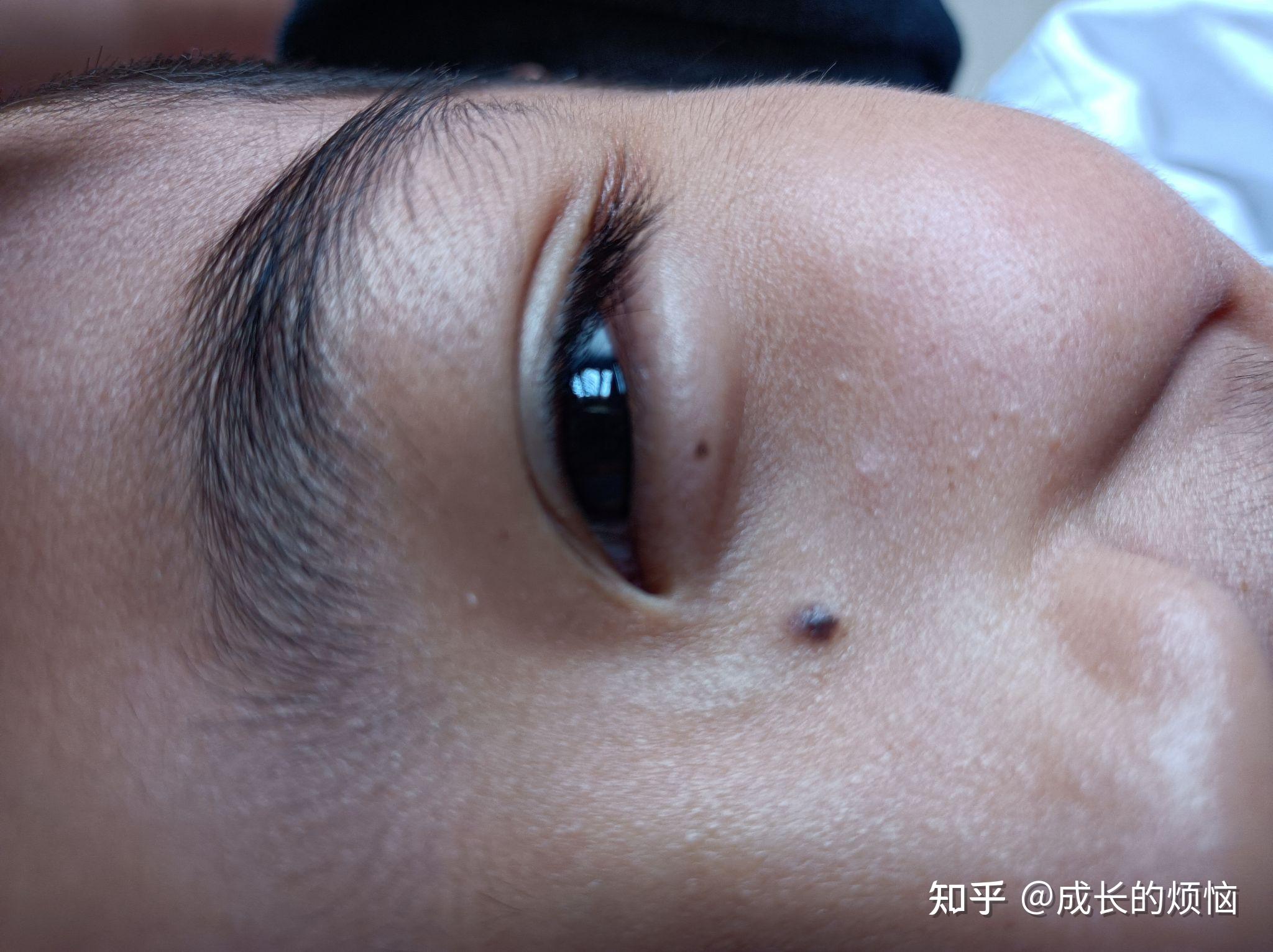 坐标北京·手术祛痣·下眼睑痣记录贴 - 知乎