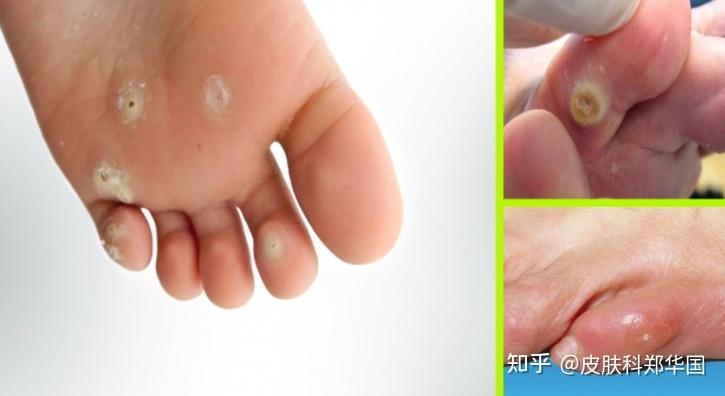 鸡眼形成的原因有哪些?