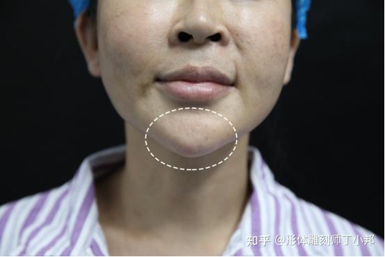 杭32岁刘女士，不顾家人反对到北京取出下巴注射的生长因子，分享整形经历 知乎 