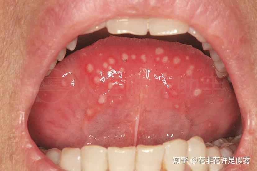 口腔溃疡,除了自愈还能如何治疗? - 知乎