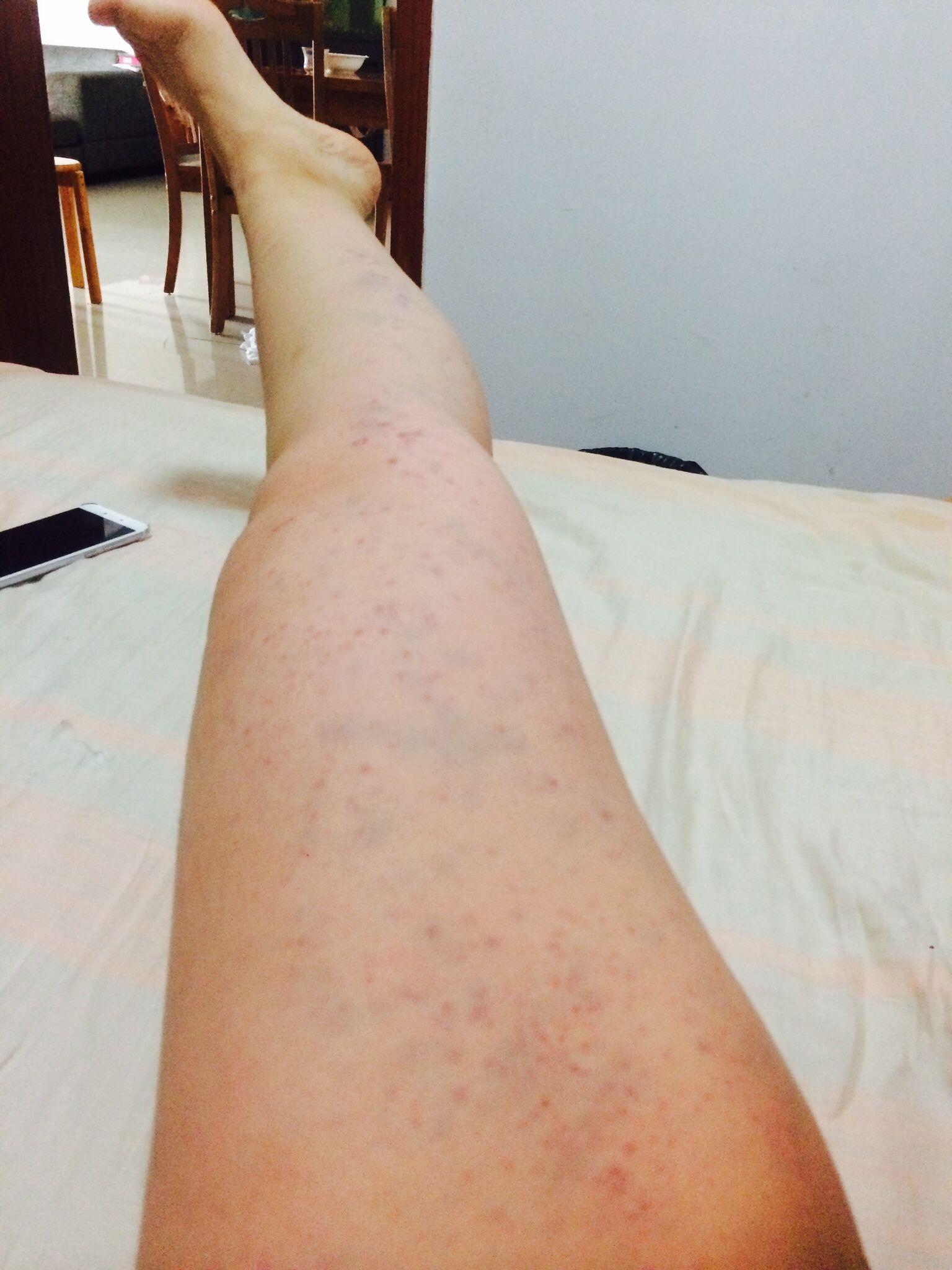 拍打排毒是什么原理是毛细血管出血吗