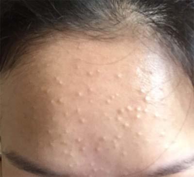 你豆教你清楚认识闭合性粉刺和治疗方法- 知乎