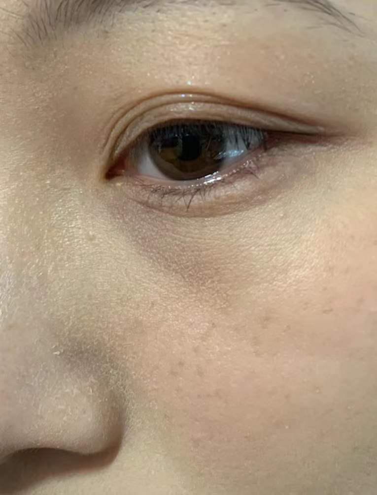 我今年十八岁请各位知友看一下我的眼睛下面这种纹是不是眼周细纹没救