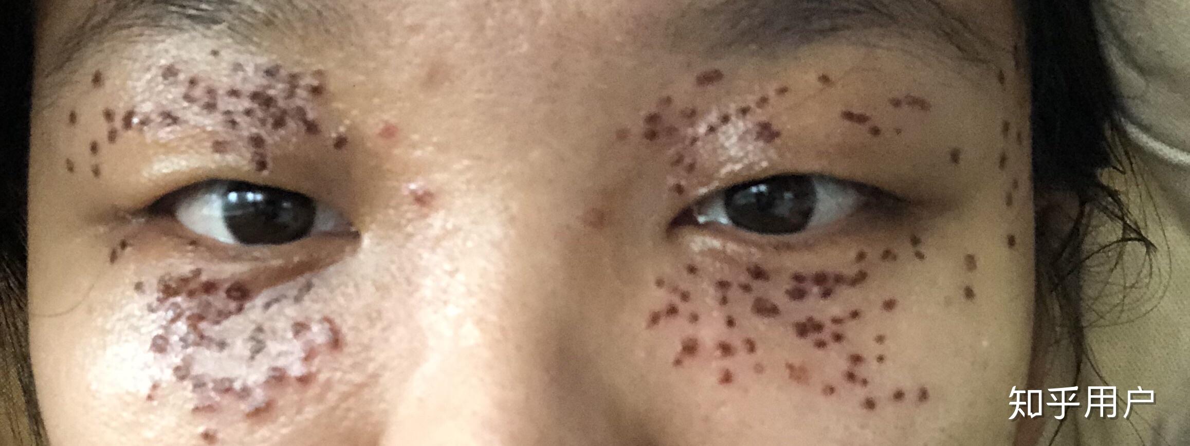 眼睛周围长了很多汗管瘤,怎么办?