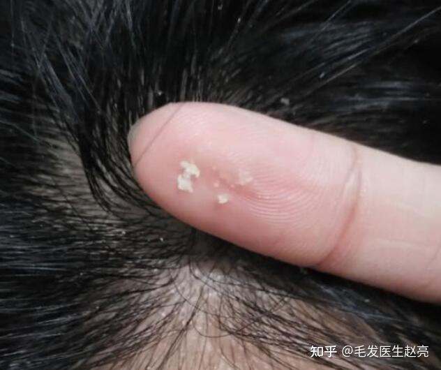 经常摸到头皮上硬硬的小颗粒当心形成毛囊炎