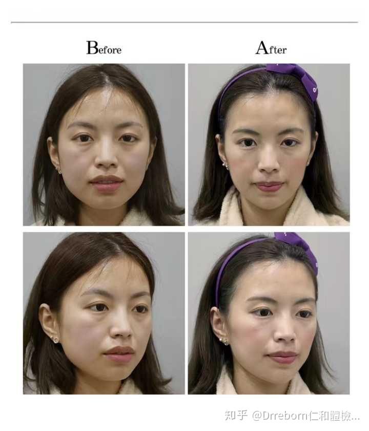 香港医美82少女针洢莲丝对比图与过程