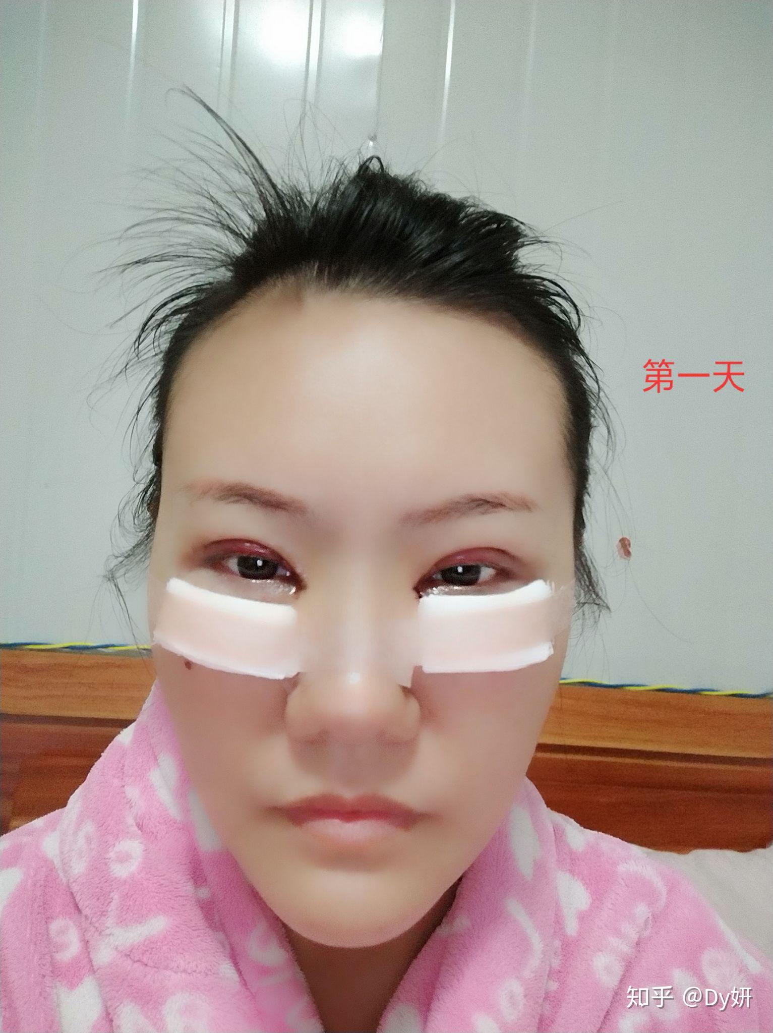郑州做双眼皮手术方法,翘睫无痕双眼皮_郑州双眼皮医生-站酷ZCOOL