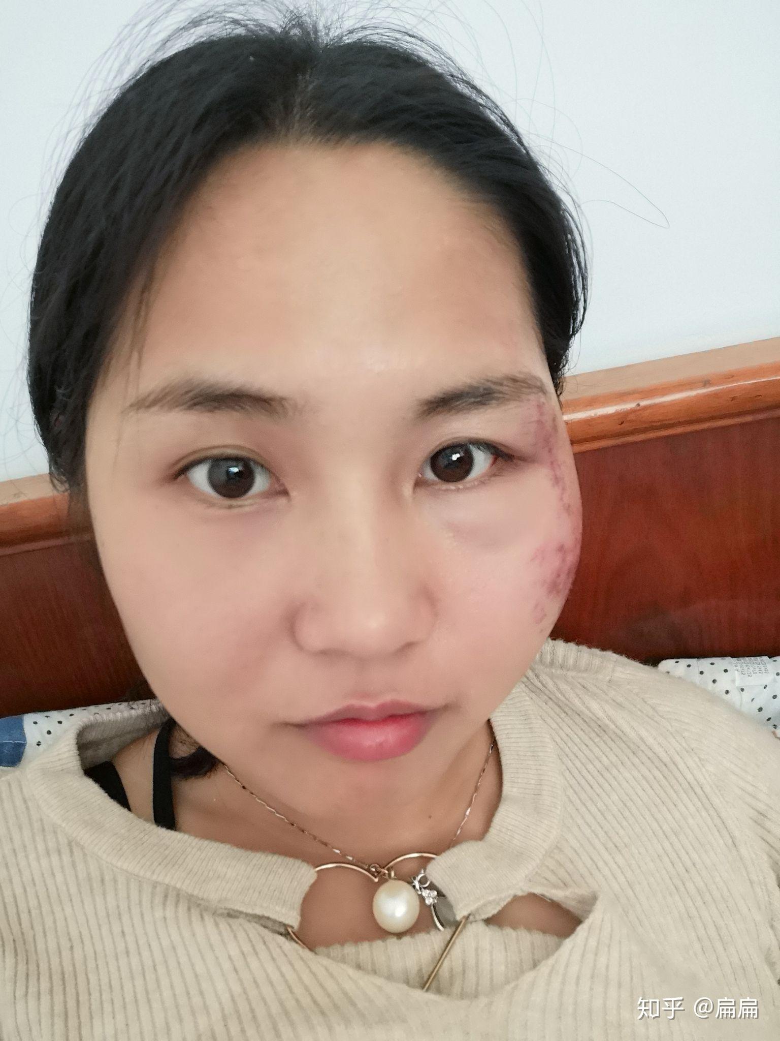 脸部擦伤结痂已经掉了.但是红黑的一片,怎样才能避免留疤? - 知乎