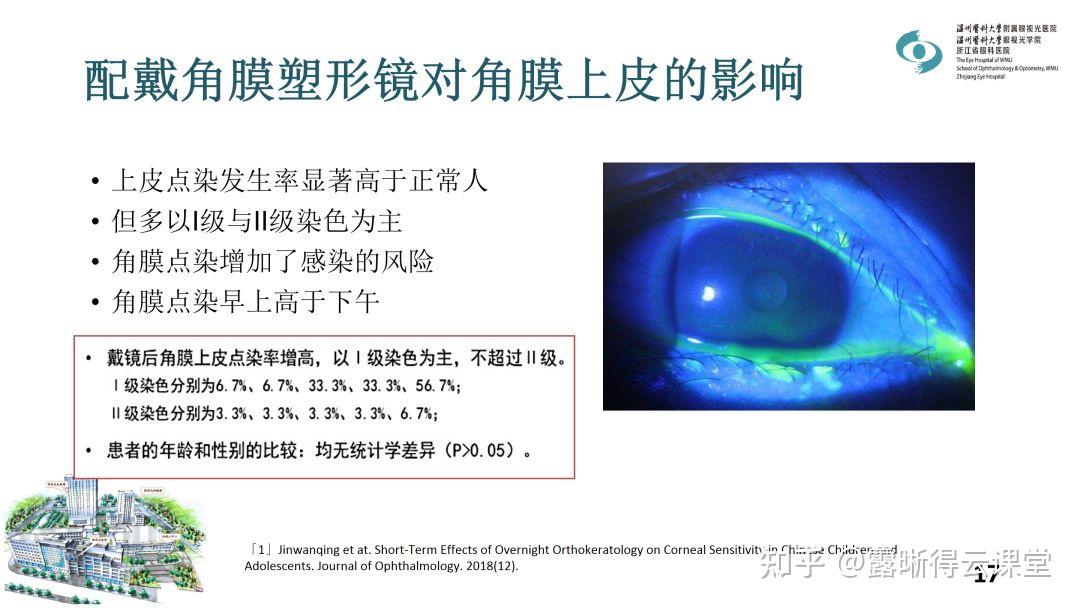 角膜塑形镜对眼表的影响研究（文字版） - 知乎