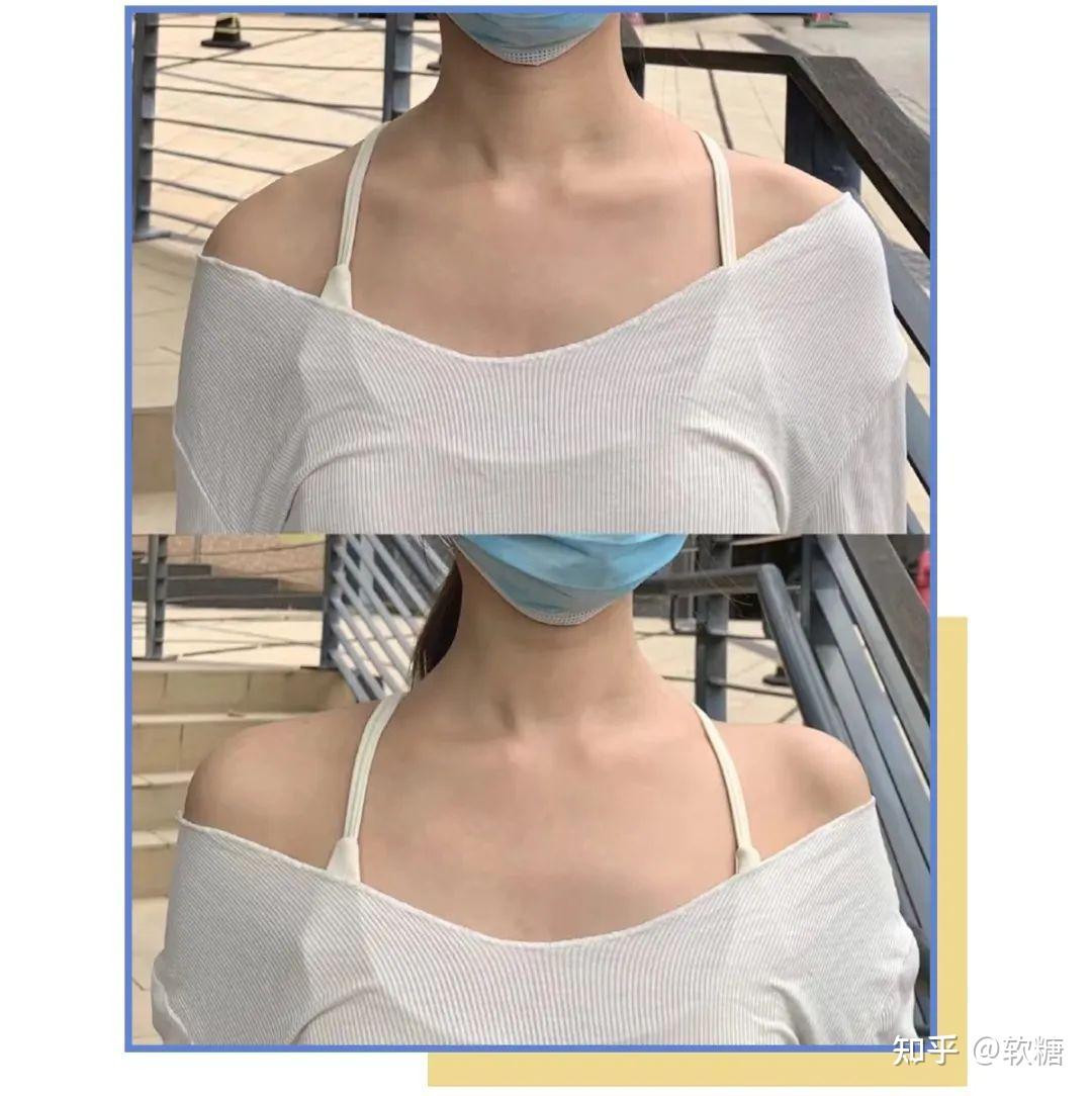 如何把溜肩练成直角肩? - 知乎