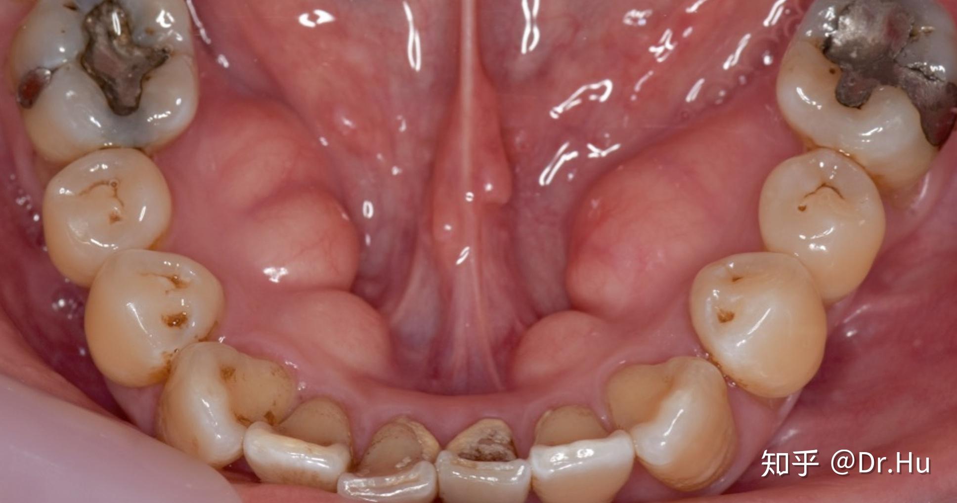 口腔下颚有个凸起异物图片