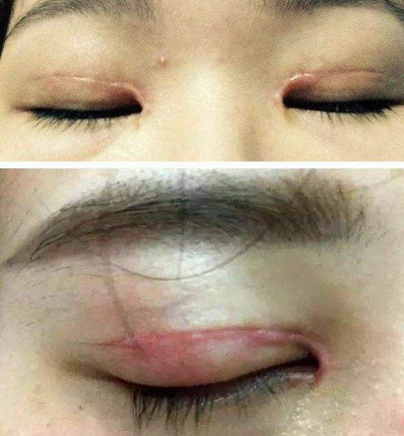 关于眼整形要知道的事(四):双眼皮术后出现疤痕增生怎么办?