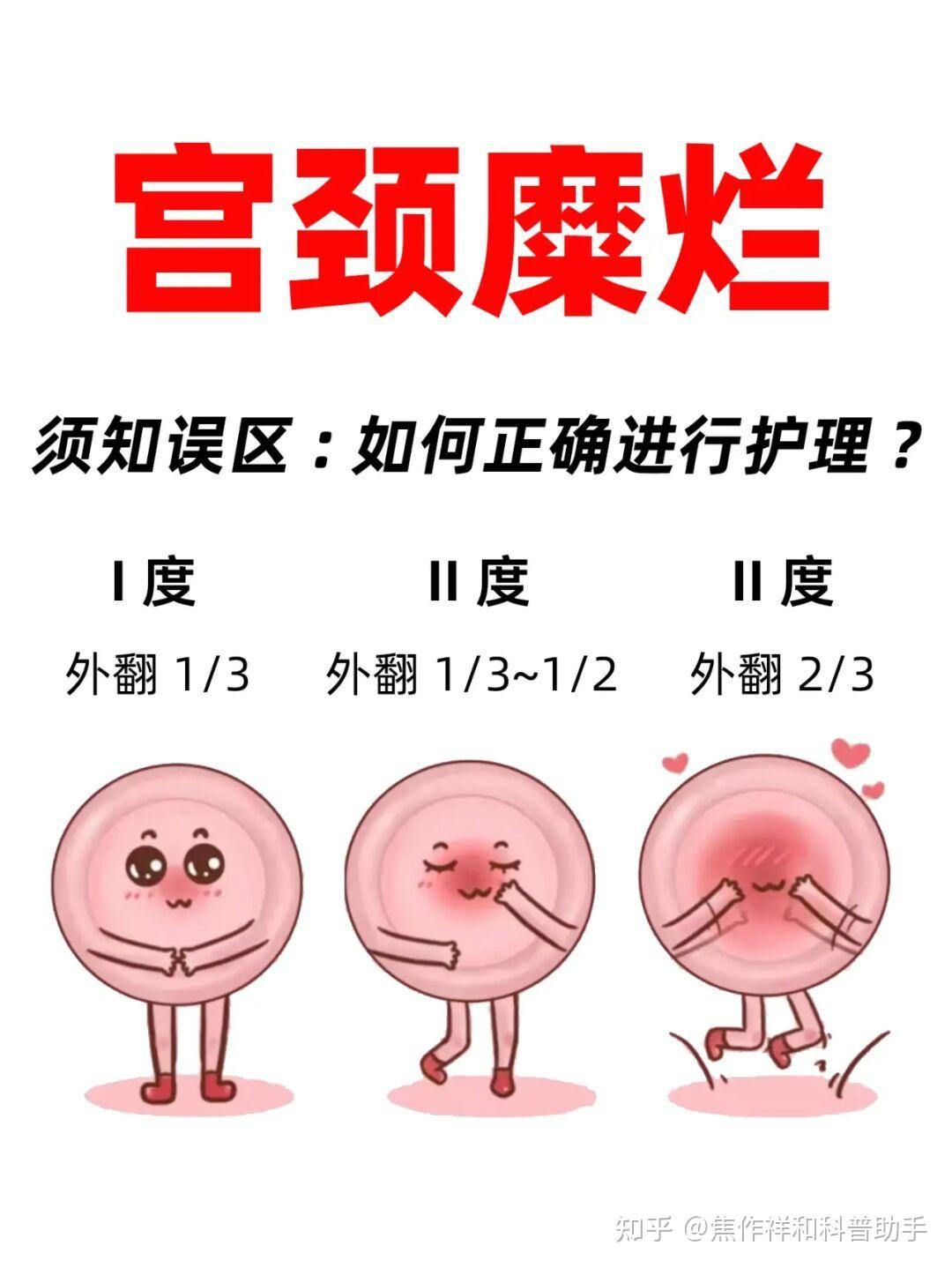 宫颈糜烂到底是怎么治疗? - 知乎