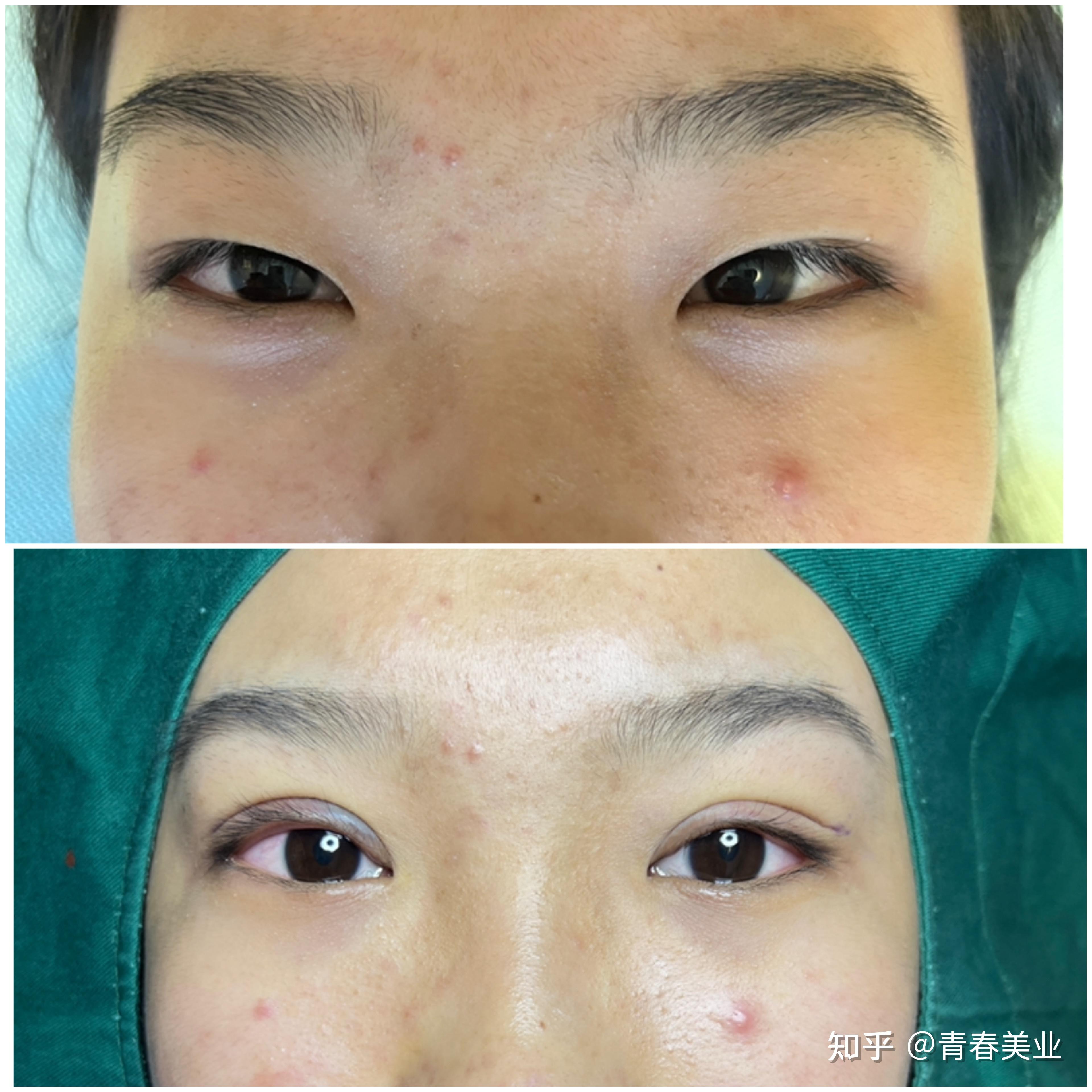 眼尾上翘77眼间距过大单眼皮调整双眼皮细节