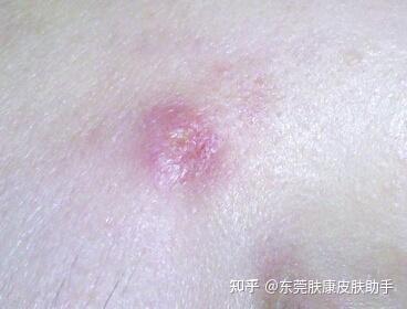 脸上长火疖子的原因是什么? - 知乎