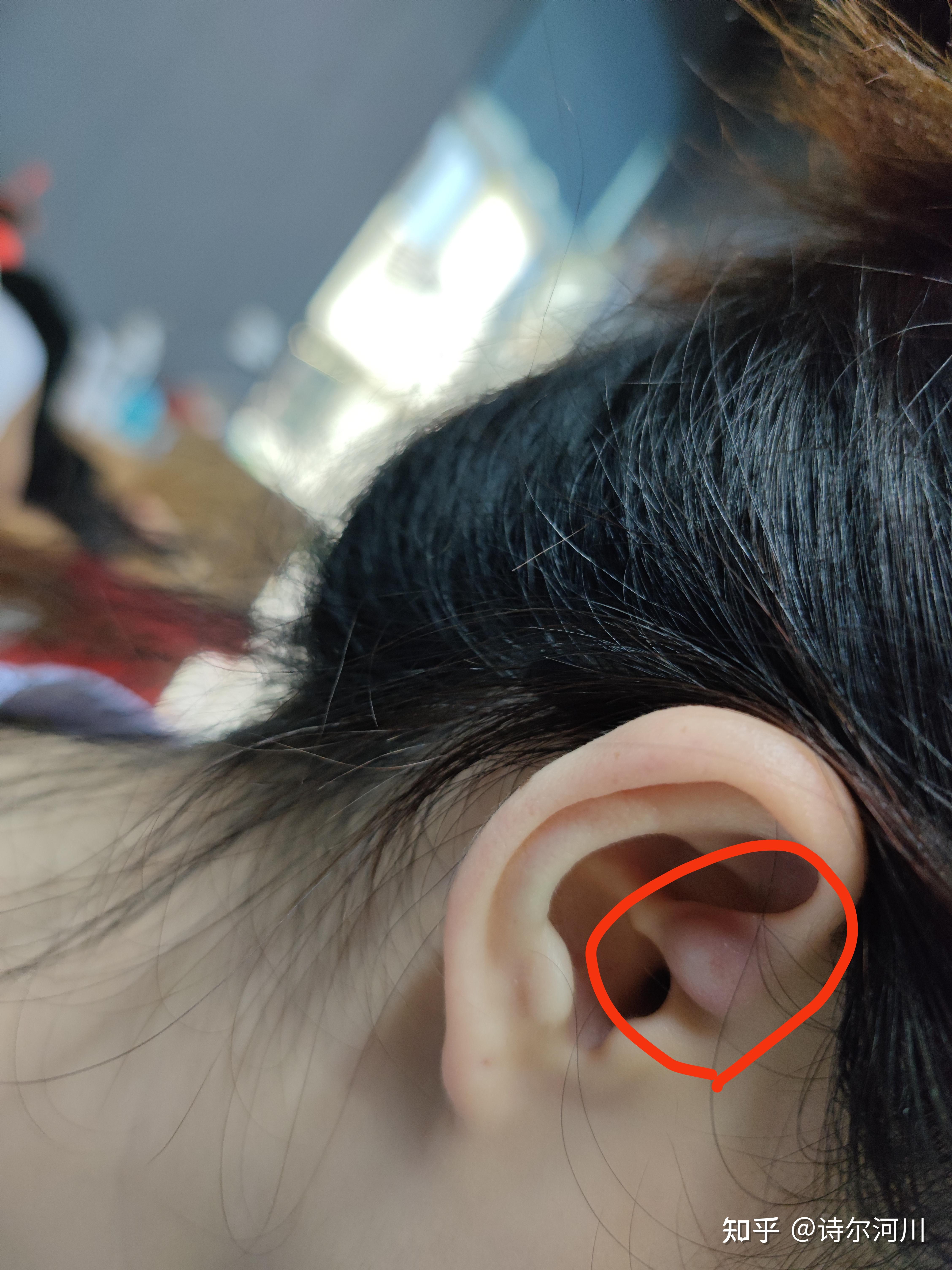 皮脂腺囊肿初期长啥样? - 知乎