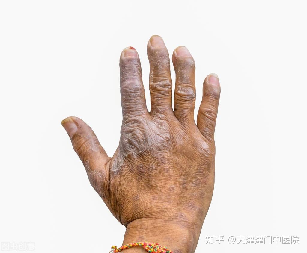 日常做到这几点有效控制银屑病